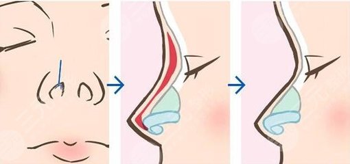 肋骨隆鼻3个月内变化