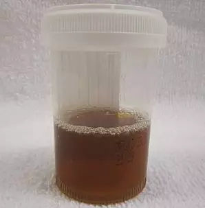 小便茶色是怎么回事