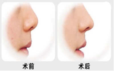 玻尿酸填充鼻子后遗症
