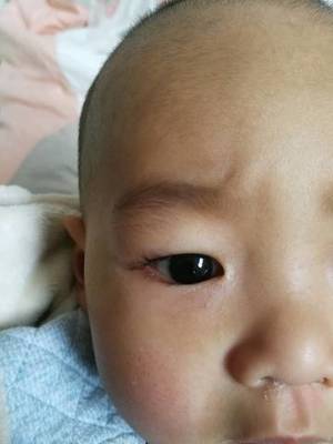 脸上突然才小痘痘