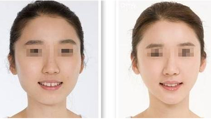 脸部吸脂费用是多少