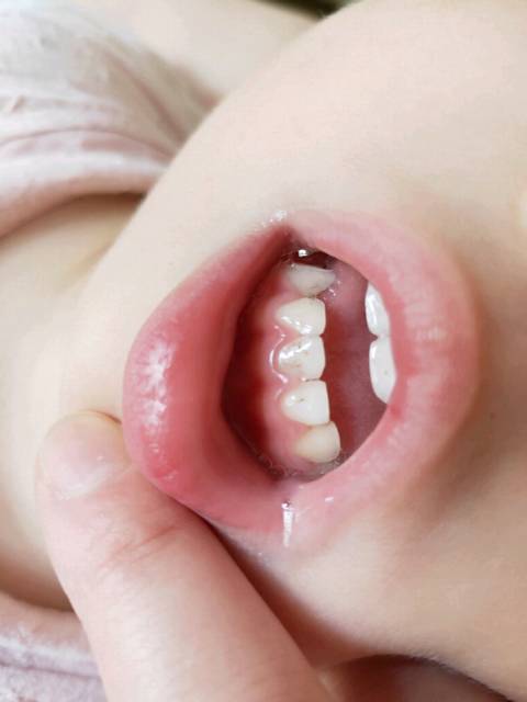 3岁宝宝牙齿