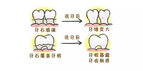 洗牙的步骤