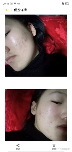 有痘痘可以涂素颜霜