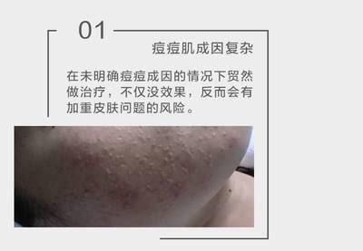 痘痘肌的四个成因