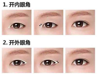 内眦赘皮双眼皮
