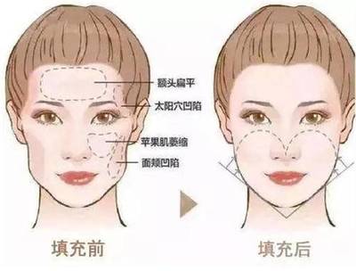 脸部填充脂肪的副作用