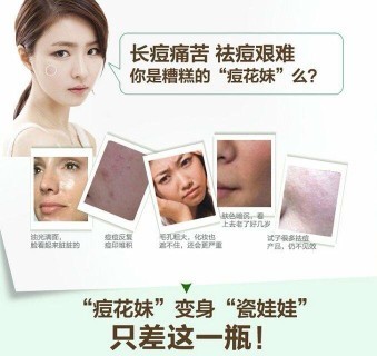 韩国 痘痘