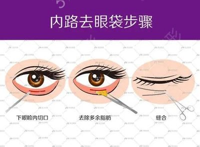 怎么治疗大眼袋