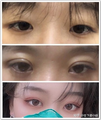 割一双眼皮多少钱