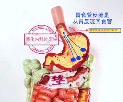 胃烧心怎么治疗