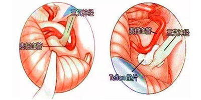 三叉神经疼是怎么回事