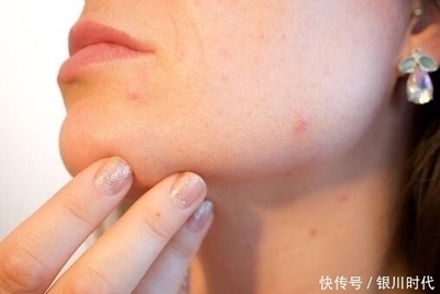 脸上痘痘发痒