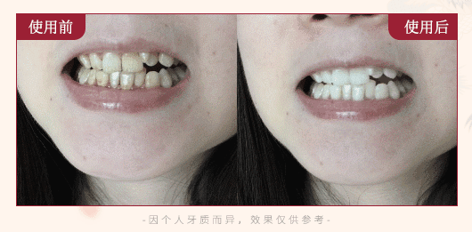 口腔溃疡为什么自己变好