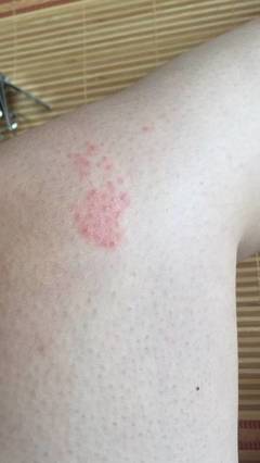 红痘痘怎么让它长出来