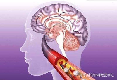 脑梗是怎么回事