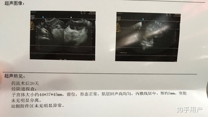 刚发现怀孕能药流吗