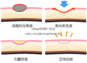 激光祛痣原理