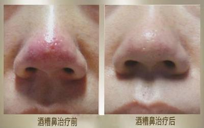 酒糟鼻子怎么治疗效果好
