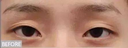 割完双眼皮想再开眼角