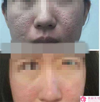 脸上凹陷疤痕可以整平吗,十几年凹陷的疤痕能修复吗?