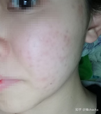 吃什么可以去痘印