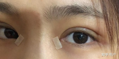 割了双眼皮多久可以碰水