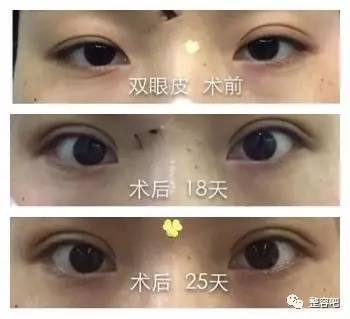 双眼皮自述