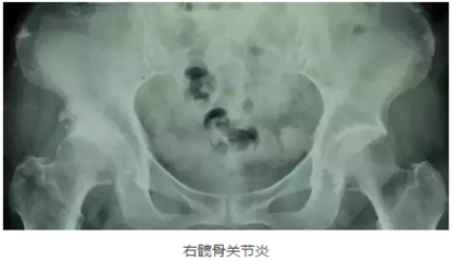 股骨头囊变是怎么回事