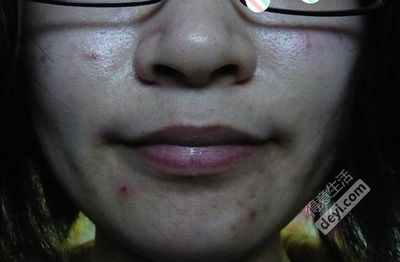 脸上的痘痘怎么消炎