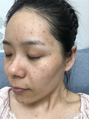 做了光子嫩肤痘痘变多了