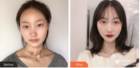 疤痕软化针的价格