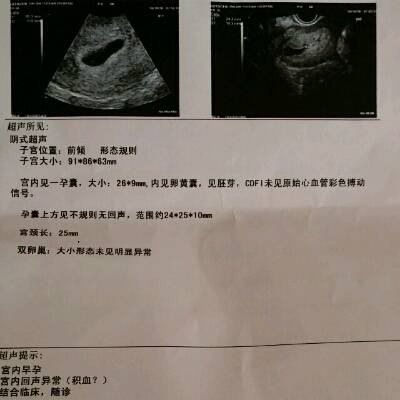 孕囊里没有胚芽是怎么回事
