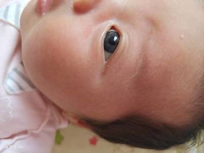 宝宝眼白上有灰色斑块