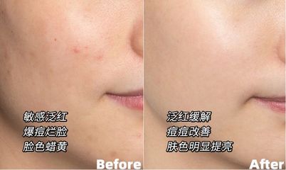 做了光子嫩肤痘痘变多了
