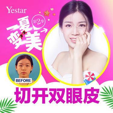 济南曲梅双眼皮