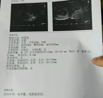 怀孕3个月孕囊多大
