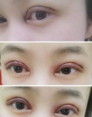 双眼皮的坏处