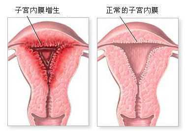 内膜增厚怎么治疗好