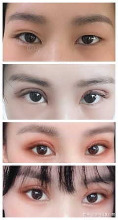 做双眼皮的形状