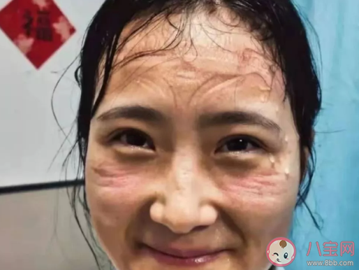 脸上痘痘怎么缓解