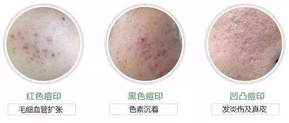 痘痘挤压变成色素