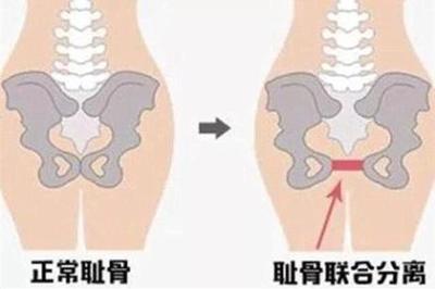 孕妇 耻骨联合分离