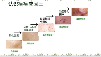 痘痘和粉刺怎么区分