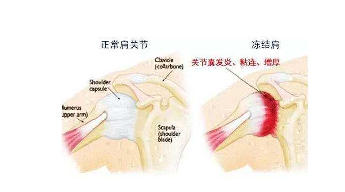 肩关节疼痛怎么治疗