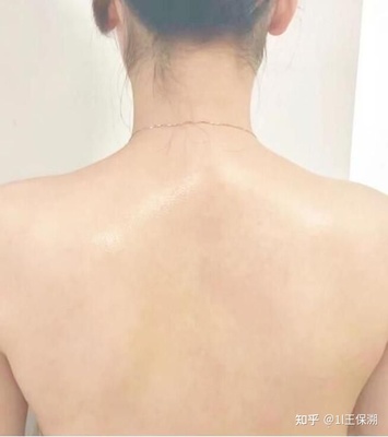 后背突然开始长痘痘怎么办