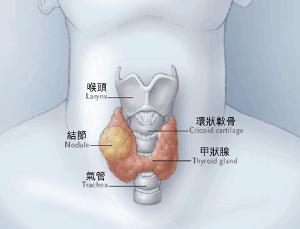 甲状腺癌