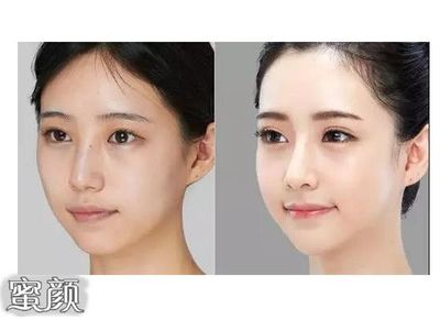 脸抽脂
