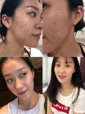 去痘印的中药面膜