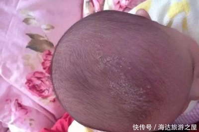 新生儿乳痂图片